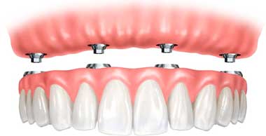 Dental Implant Treatments