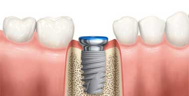 Dental Implant Treatments