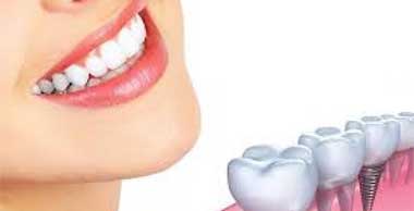Dental Implant Treatments