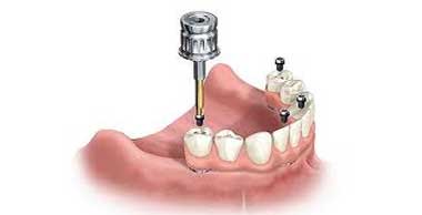 Dental Implant Treatments