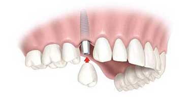 Dental Implant Treatments
