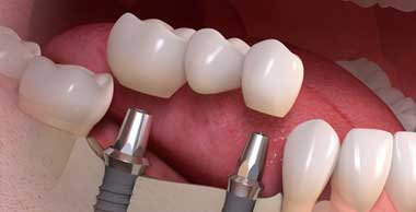 Dental Implant Treatments