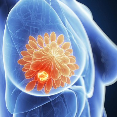 breast diseases