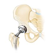 Hip Replacements
