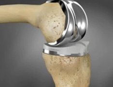 Knee Replacements