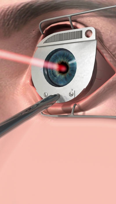 glaucoma