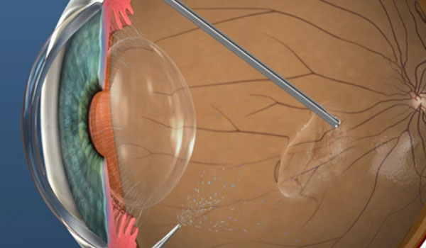 vitreo Retina